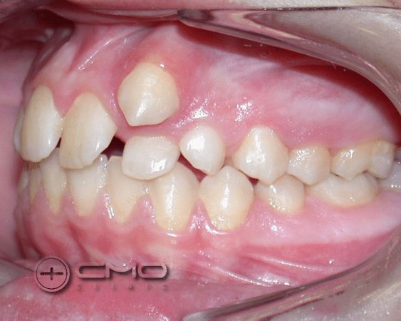 ortodontia antes