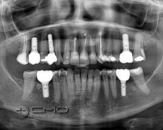 O Sorriso Desejado - Invisalign + Implantes