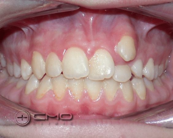 ortodontia antes