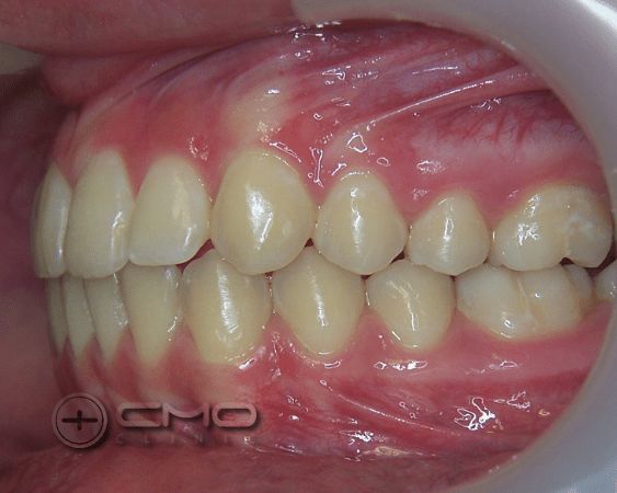 correção dos maxilares e dentes