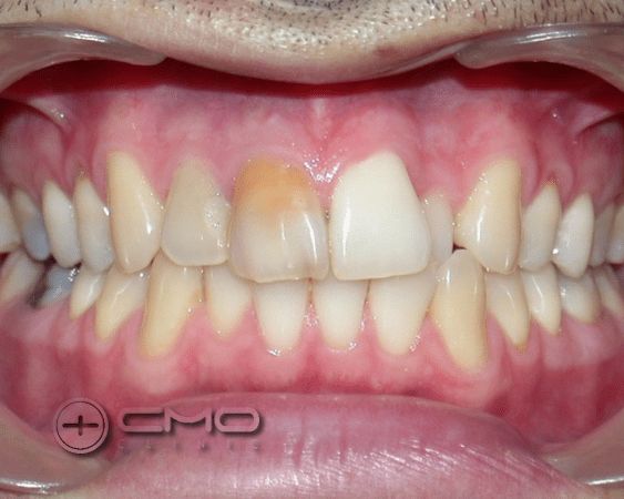 ortodontia e coroas