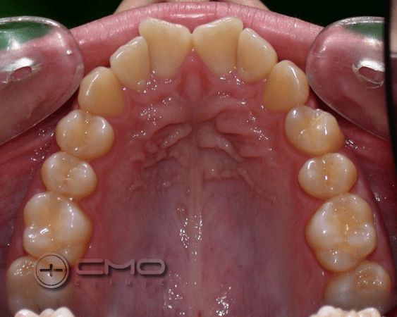 ortodontia e branqueamento