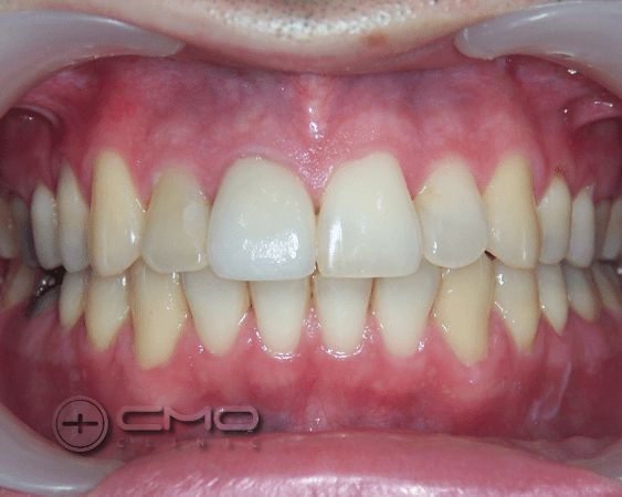 ortodontia e coroas