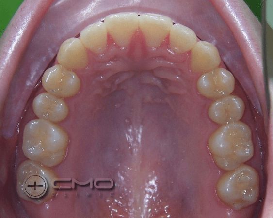 ortodontia e branqueamento