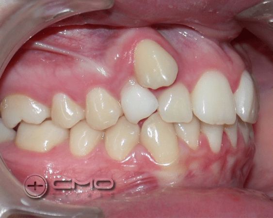 dente ectópico antes lateral
